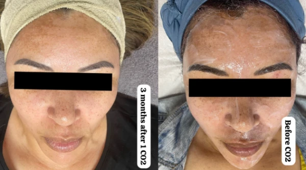 CO2-Skin-Laser-2