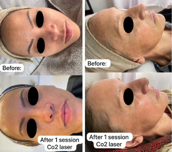 CO2-Skin-Laser-3