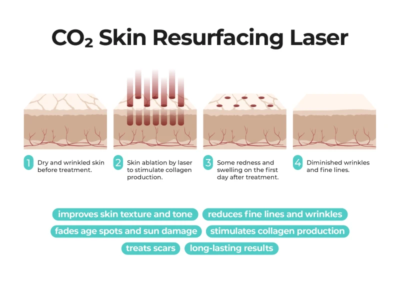 CO2-Skin-Laser