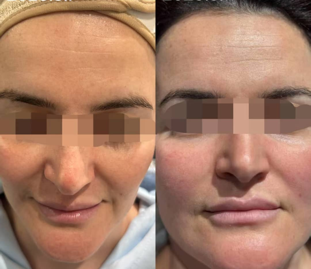 Before-After-CO2-Laser-Treatment-Cape-Town-2