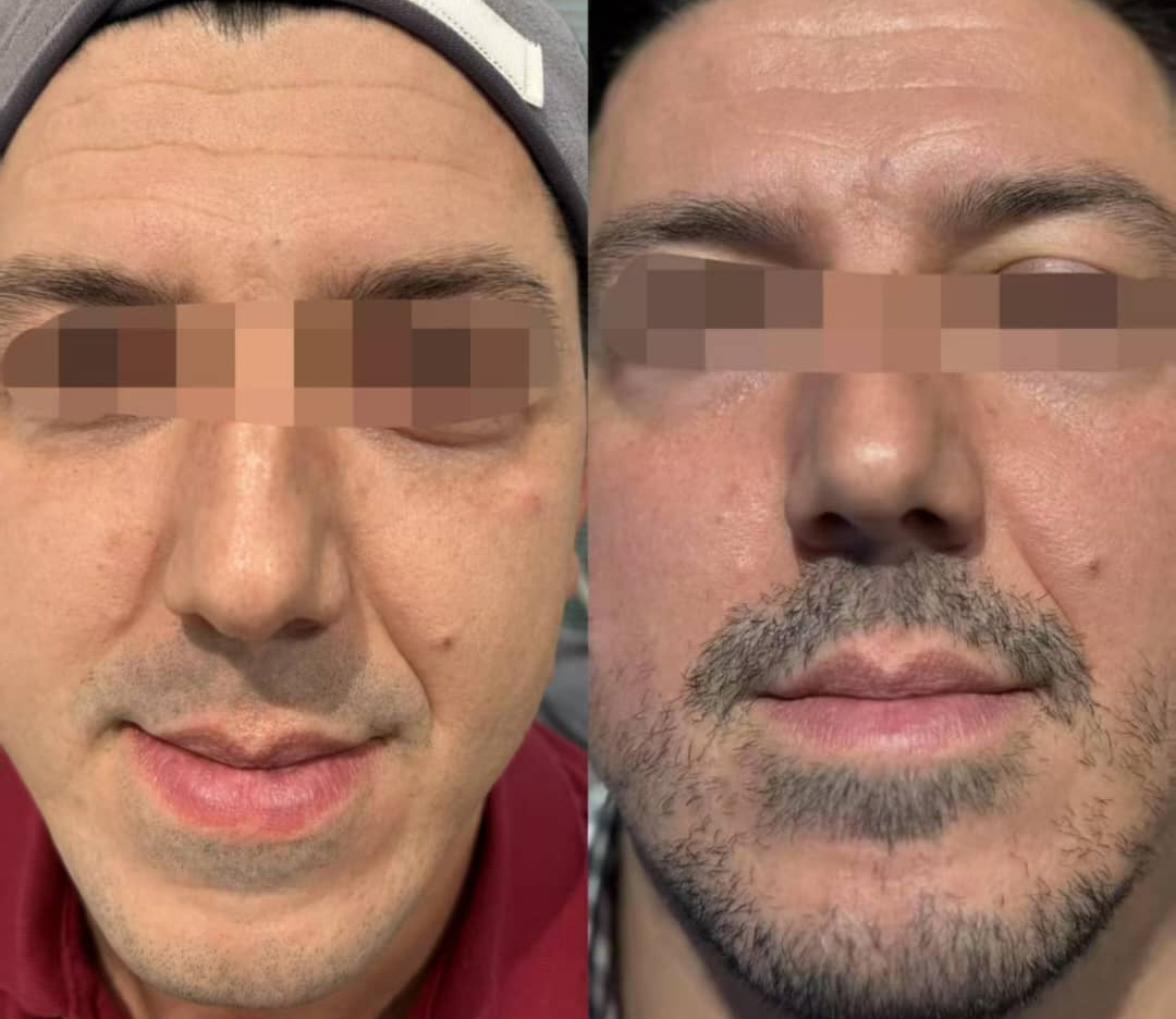 Before-After-CO2-Laser-Treatment-Cape-Town-3