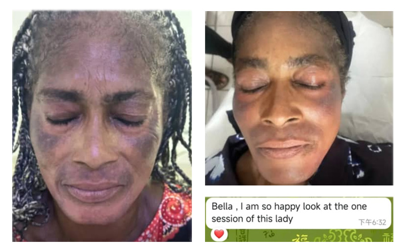 Before-After-CO2-Laser-Treatment-Cape-Town