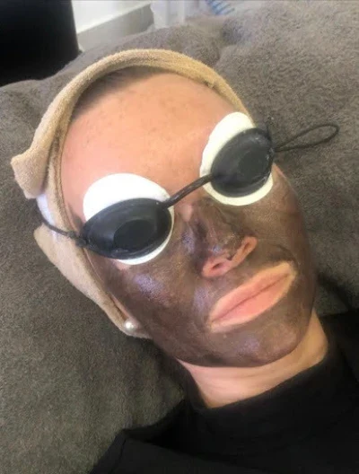 Carbon Laser Facial Cape Town
