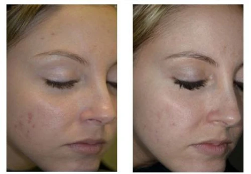Chemical Peel Cape Town