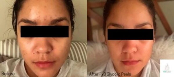 Chemical Skin Peel Cape Town