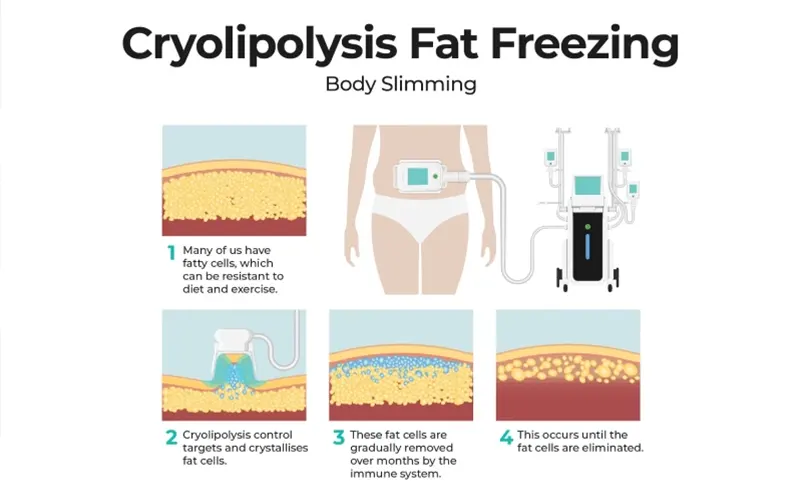 Fat Freezing Cryotech Cape Town