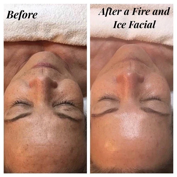 Fire & Ice Facial Before After