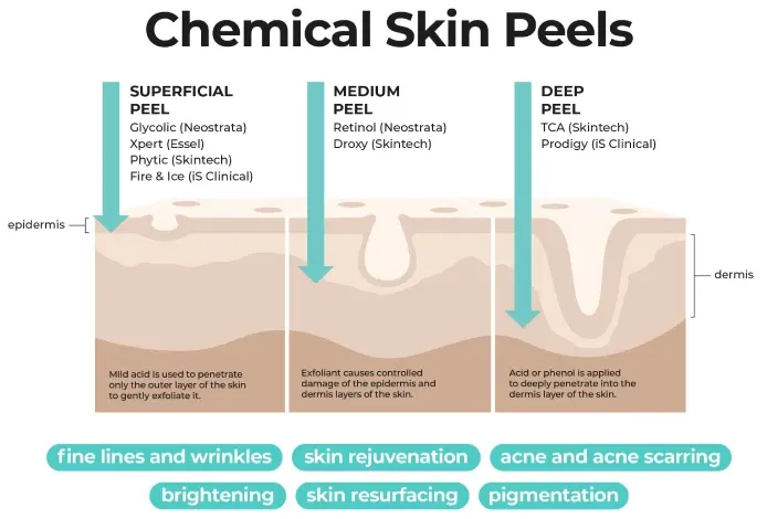 Glycolic Peel Cape Town