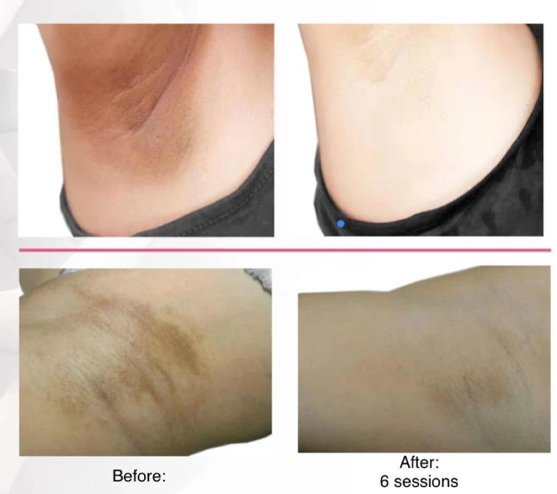Intimate Peel Before After