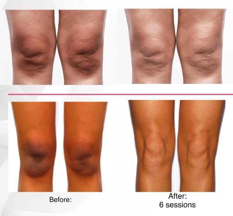 Intimate Skin Peel Before After