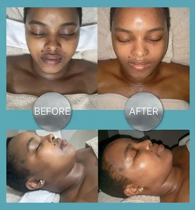 QMS Medicosmetics Before After