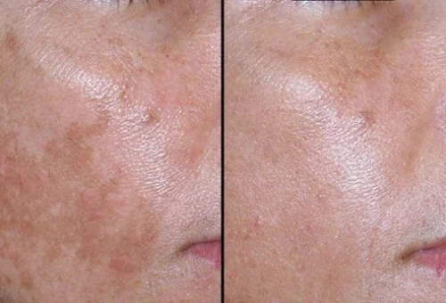 Retinol Peel Before After