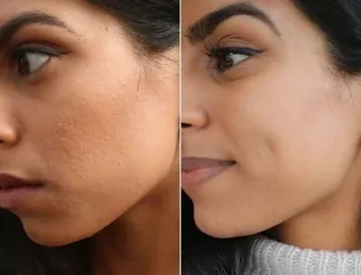 Retinol Peel Cape Town