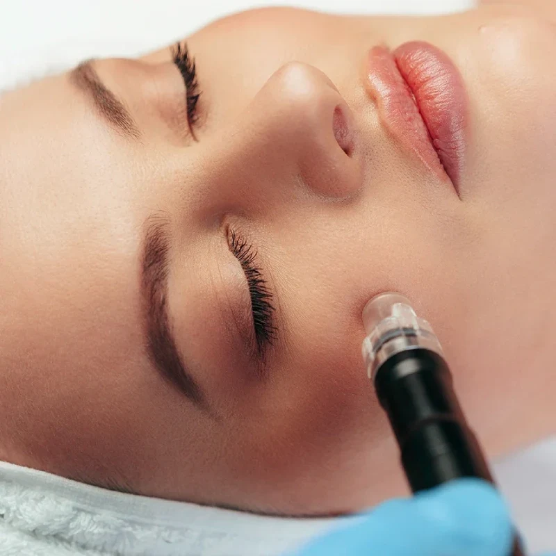 Skin Needling Cape Town