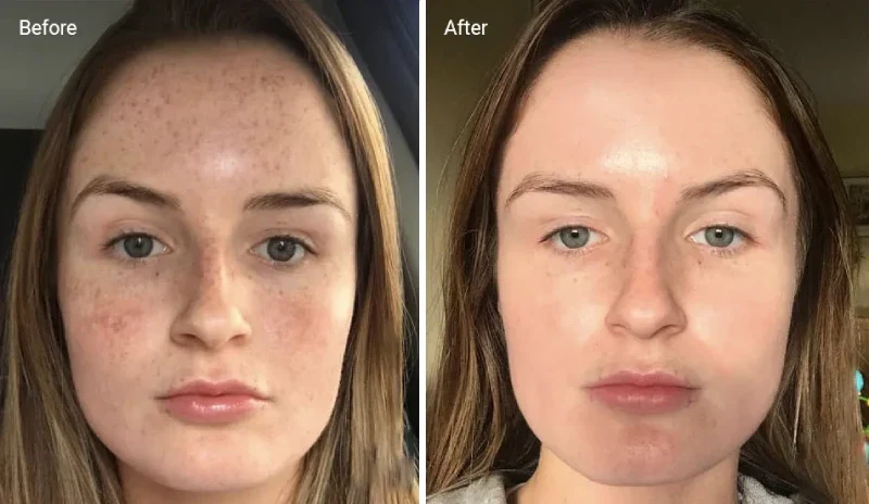 TCA Peel Before After