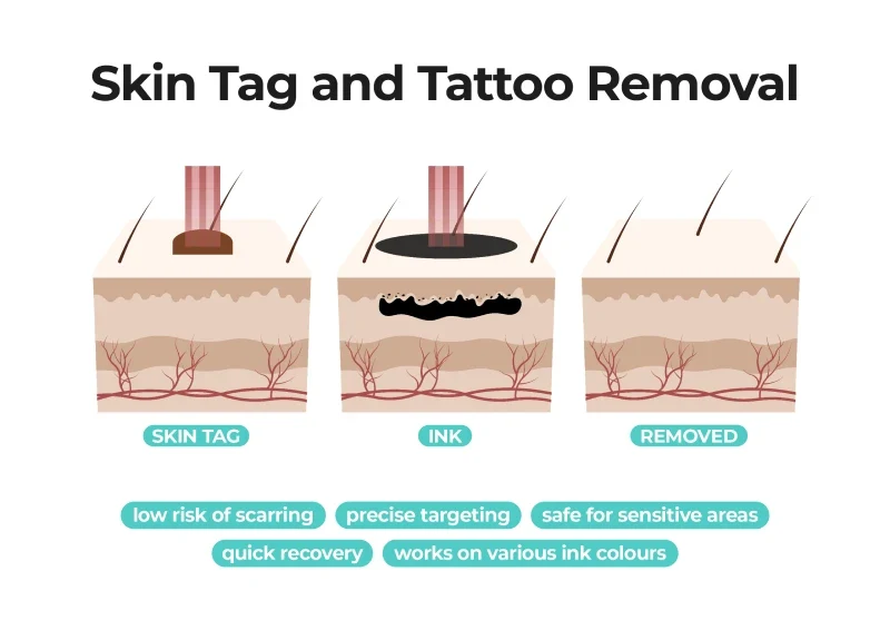 Tattoo Removal Laser Cape Town