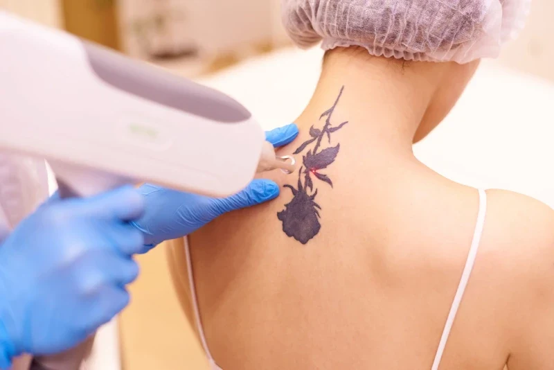 Tattoo Removal Laser Cape Town