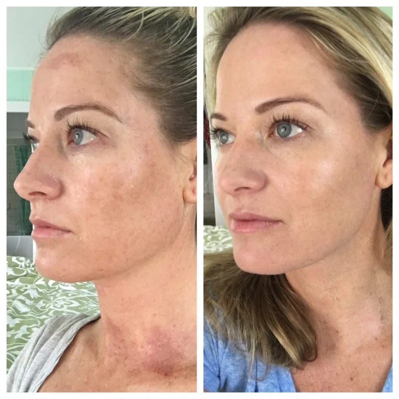 Trichloroacetic Acid Peel Cape Town