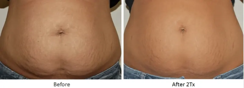 V8 Body Contouring Before After